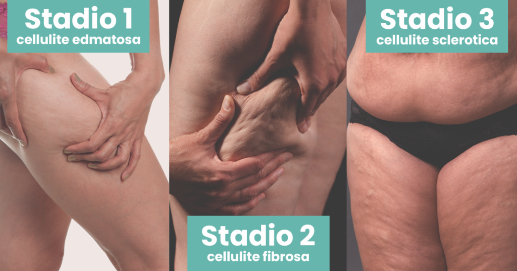 I tre stadi della cellulite